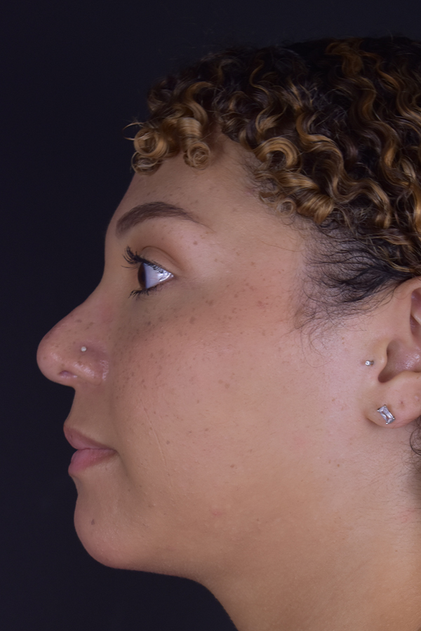 Rhinoplasty Before and After | Northside Plastic Surgery