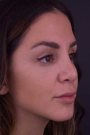 Rhinoplasty Before and After | Northside Plastic Surgery