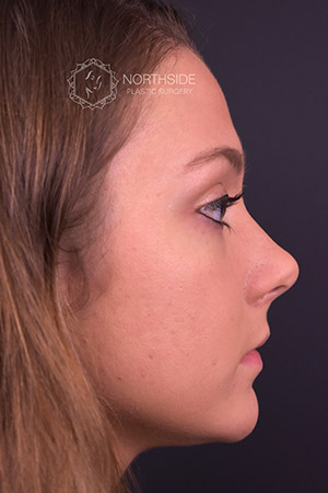 Rhinoplasty Before and After | Northside Plastic Surgery