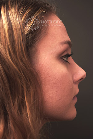 Rhinoplasty Before and After | Northside Plastic Surgery