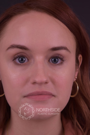 Rhinoplasty Before and After | Northside Plastic Surgery