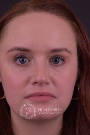 Rhinoplasty Before and After | Northside Plastic Surgery