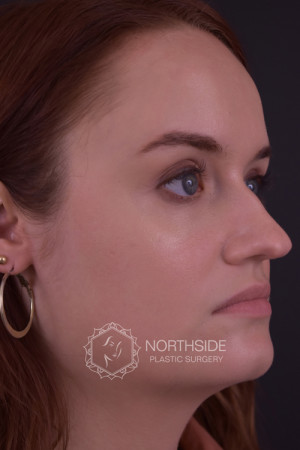 Rhinoplasty Before and After | Northside Plastic Surgery