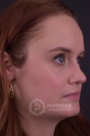 Rhinoplasty Before and After | Northside Plastic Surgery