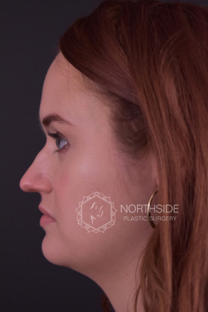 Rhinoplasty Before and After | Northside Plastic Surgery