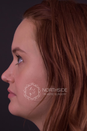 Rhinoplasty Before and After | Northside Plastic Surgery