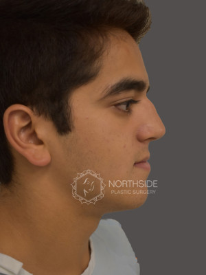 Rhinoplasty Before and After | Northside Plastic Surgery