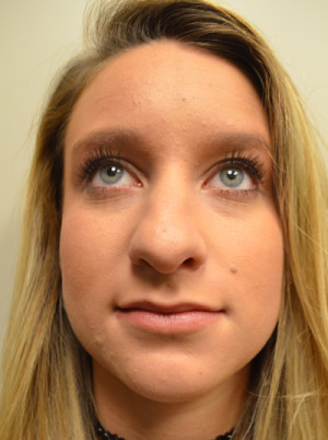 Rhinoplasty Before and After | Northside Plastic Surgery