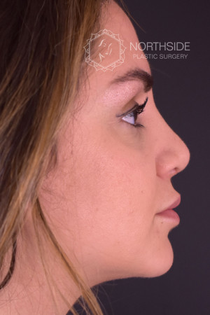 Rhinoplasty Before and After | Northside Plastic Surgery