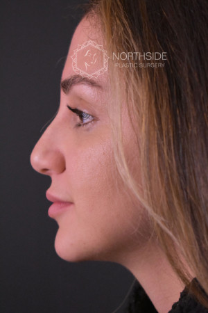 Rhinoplasty Before and After | Northside Plastic Surgery