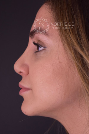 Rhinoplasty Before and After | Northside Plastic Surgery