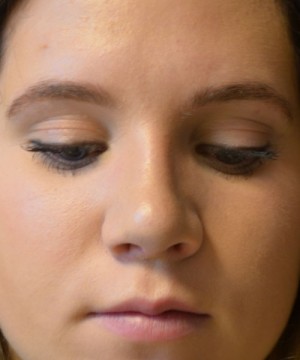 Rhinoplasty Before and After | Northside Plastic Surgery