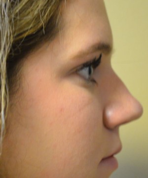 Rhinoplasty Before and After | Northside Plastic Surgery