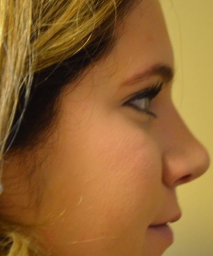 Rhinoplasty Before and After | Northside Plastic Surgery