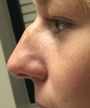 Rhinoplasty Before and After | Northside Plastic Surgery