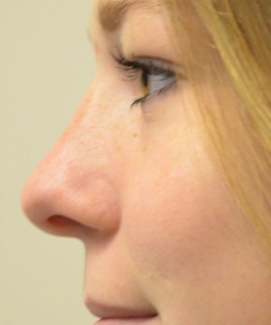 Rhinoplasty Before and After | Northside Plastic Surgery