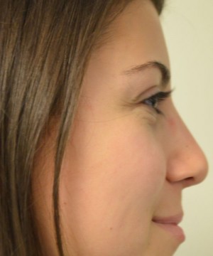 Rhinoplasty Before and After | Northside Plastic Surgery