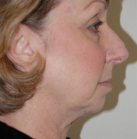 Rhinoplasty Before and After | Northside Plastic Surgery