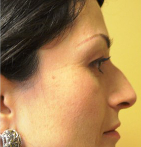 Rhinoplasty Before and After | Northside Plastic Surgery