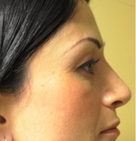 Rhinoplasty Before and After | Northside Plastic Surgery