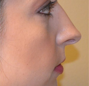 Rhinoplasty Before and After | Northside Plastic Surgery