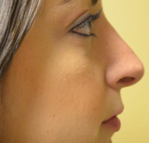 Rhinoplasty Before and After | Northside Plastic Surgery