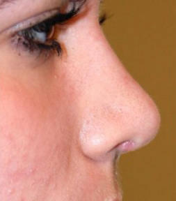 Rhinoplasty Before and After | Northside Plastic Surgery