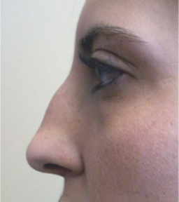 Rhinoplasty Before and After | Northside Plastic Surgery