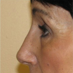 Rhinoplasty Before and After | Northside Plastic Surgery