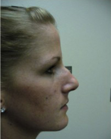 Rhinoplasty Before and After | Northside Plastic Surgery