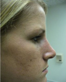 Rhinoplasty Before and After | Northside Plastic Surgery