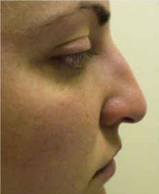 Rhinoplasty Before and After | Northside Plastic Surgery