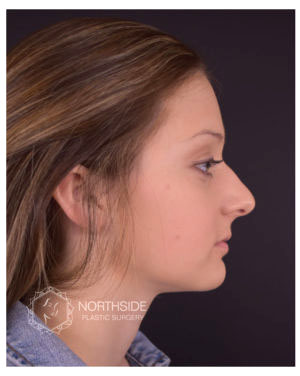 Rhinoplasty Before and After | Northside Plastic Surgery