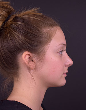 Rhinoplasty Before and After | Northside Plastic Surgery