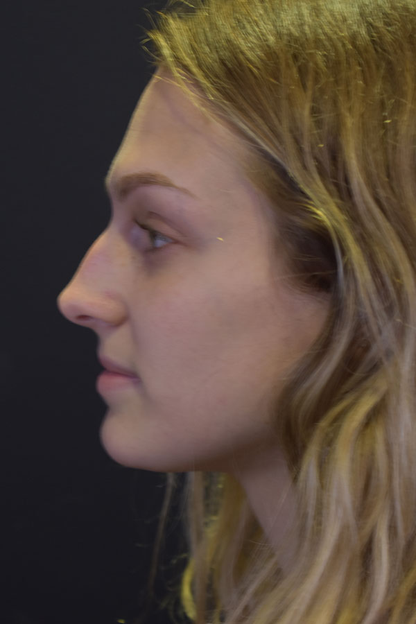 Rhinoplasty Before and After | Northside Plastic Surgery