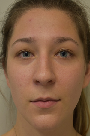 Rhinoplasty Before and After | Northside Plastic Surgery