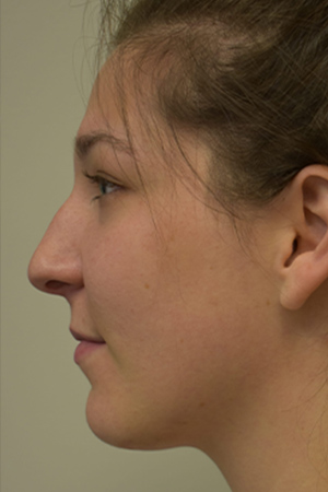 Rhinoplasty Before and After | Northside Plastic Surgery