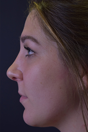 Rhinoplasty Before and After | Northside Plastic Surgery