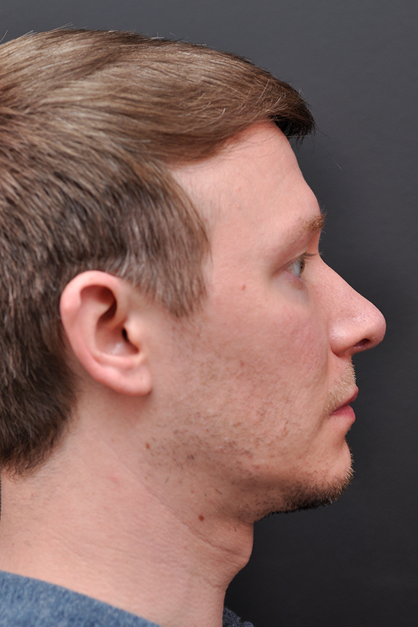 Rhinoplasty Before and After | Northside Plastic Surgery