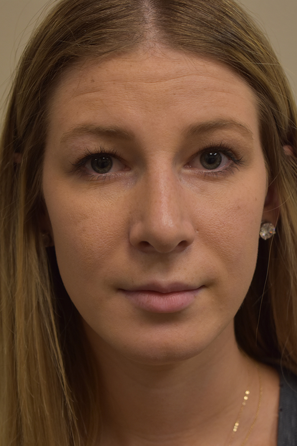 Rhinoplasty Before and After | Northside Plastic Surgery