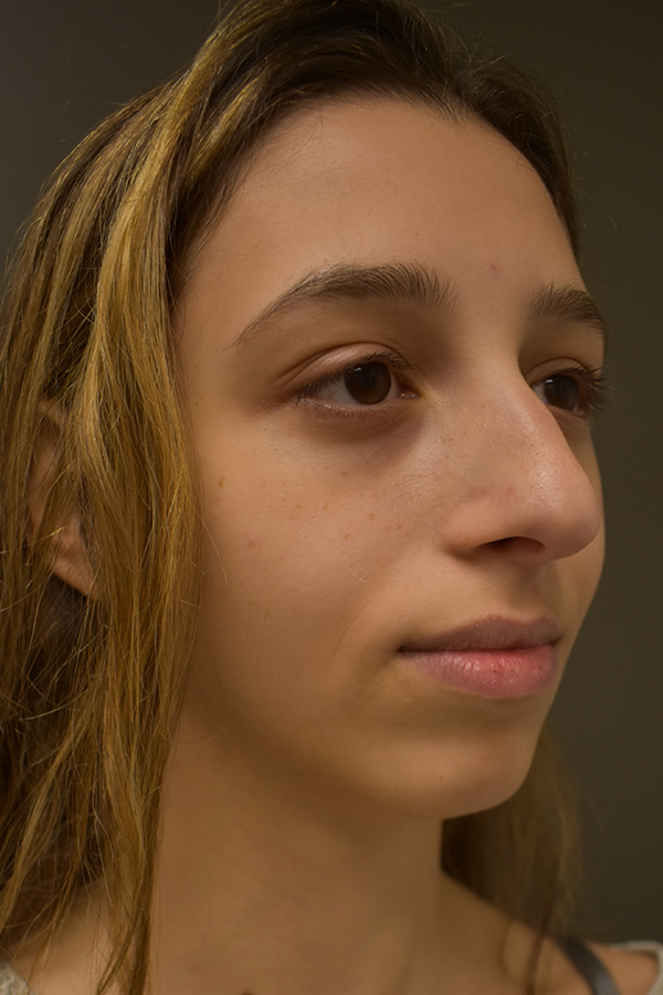 Rhinoplasty Before and After | Northside Plastic Surgery