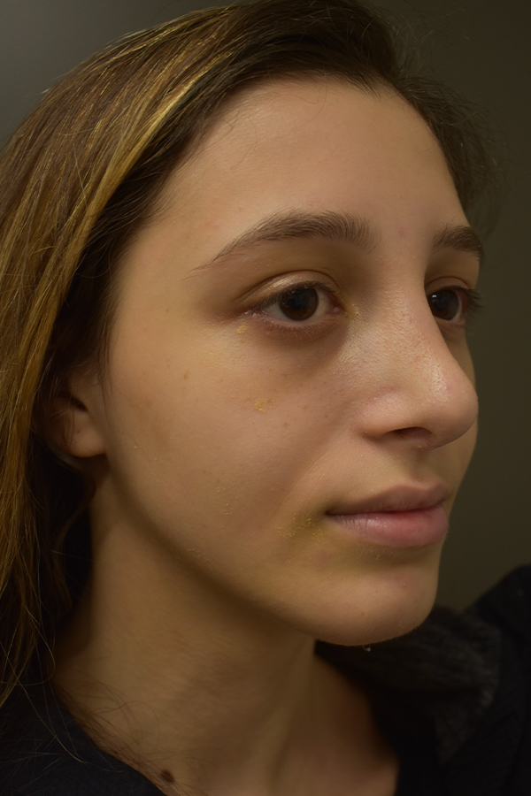 Rhinoplasty Before and After | Northside Plastic Surgery