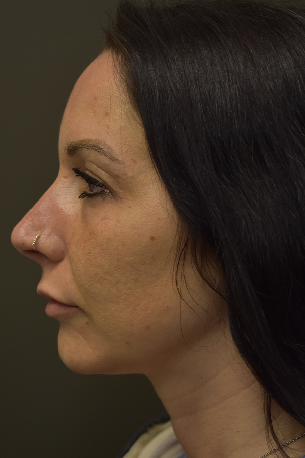 Rhinoplasty Before and After | Northside Plastic Surgery