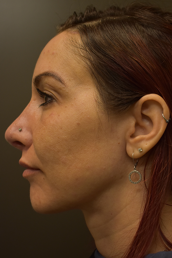 Rhinoplasty Before and After | Northside Plastic Surgery