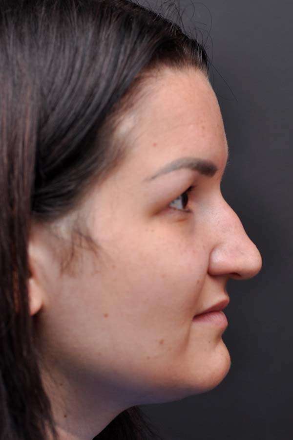 Rhinoplasty Before and After | Northside Plastic Surgery