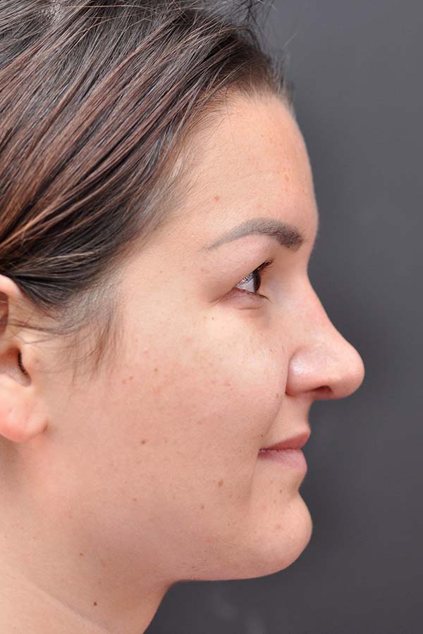 Rhinoplasty Before and After | Northside Plastic Surgery