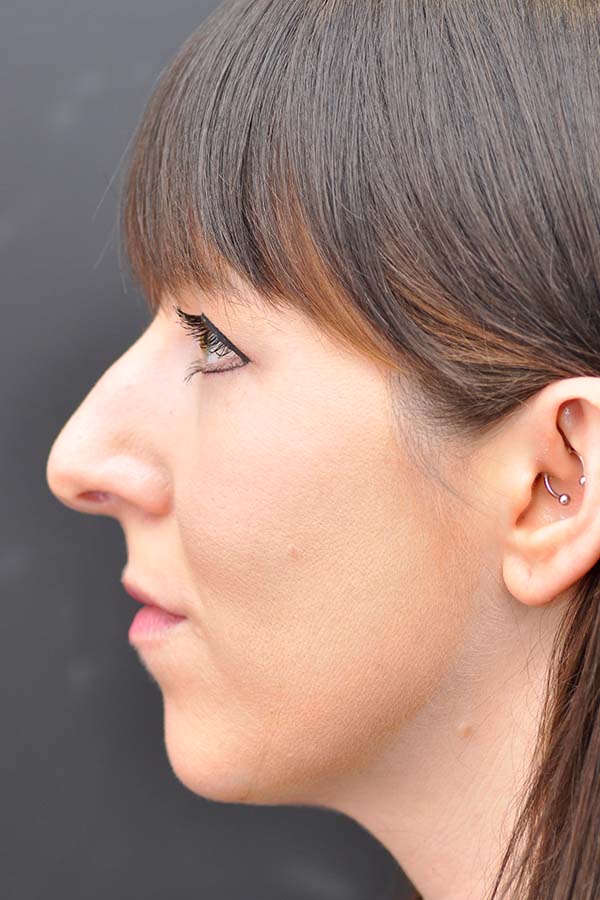 Rhinoplasty Before and After | Northside Plastic Surgery