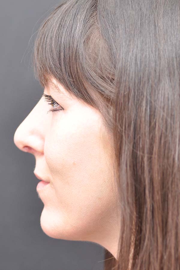 Rhinoplasty Before and After | Northside Plastic Surgery