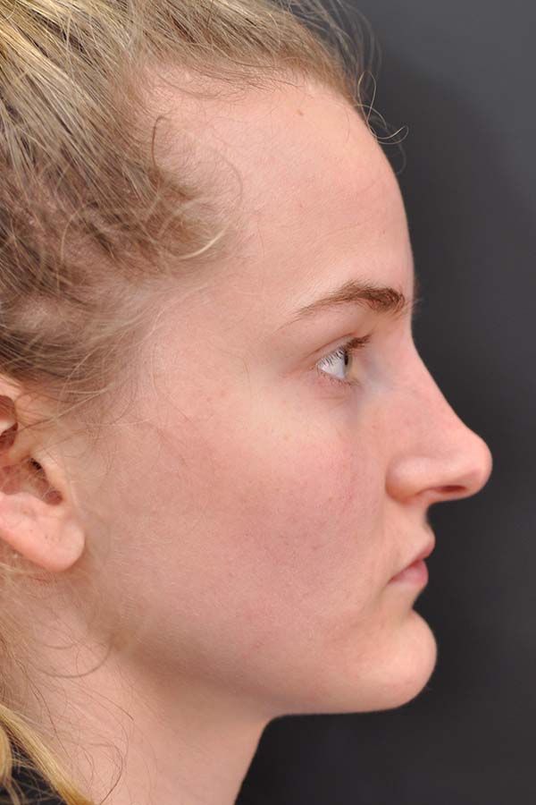 Rhinoplasty Before and After | Northside Plastic Surgery