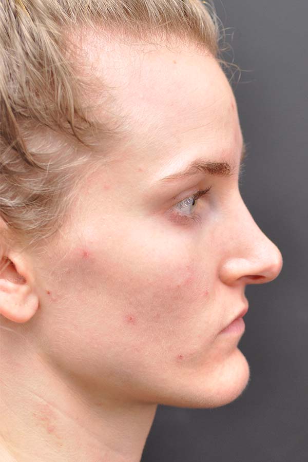 Rhinoplasty Before and After | Northside Plastic Surgery